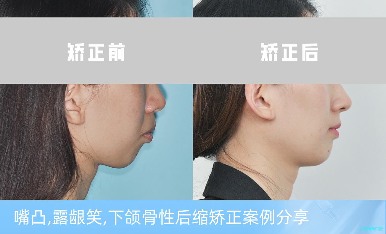义乌傅氏口腔嘴凸，露龈笑，下颌骨性后缩矫正案例分享！