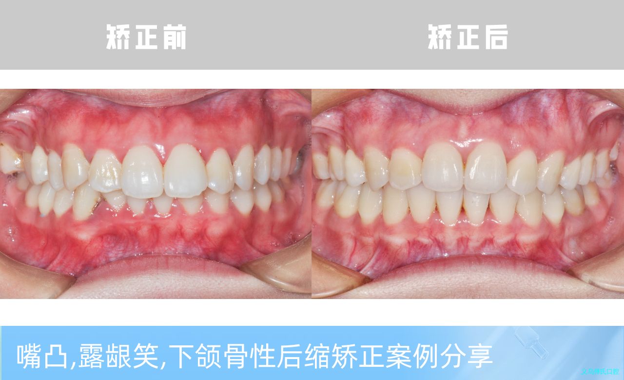 义乌傅氏口腔嘴凸，露龈笑，下颌骨性后缩矫正案例分享！