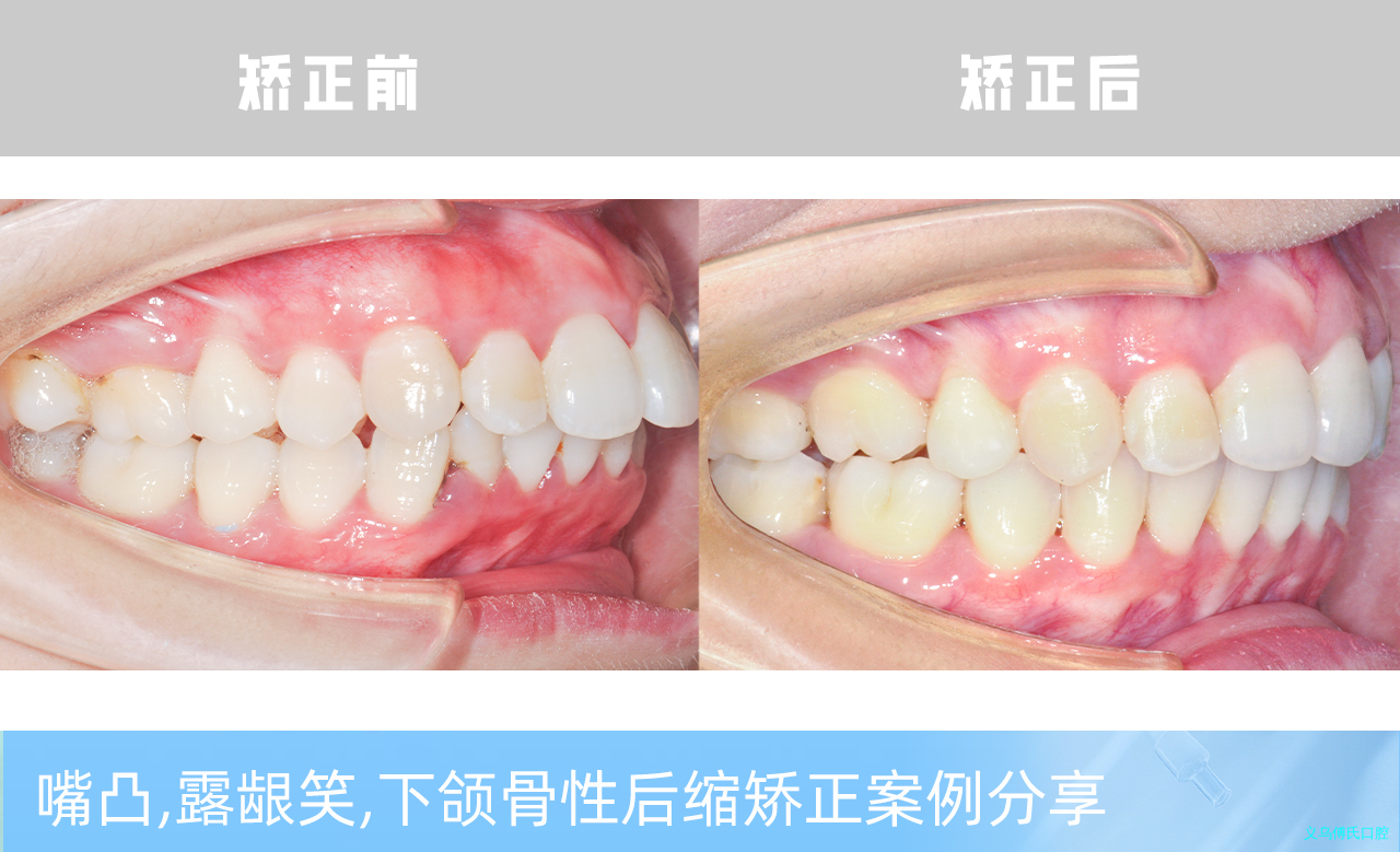 义乌傅氏口腔嘴凸，露龈笑，下颌骨性后缩矫正案例分享！