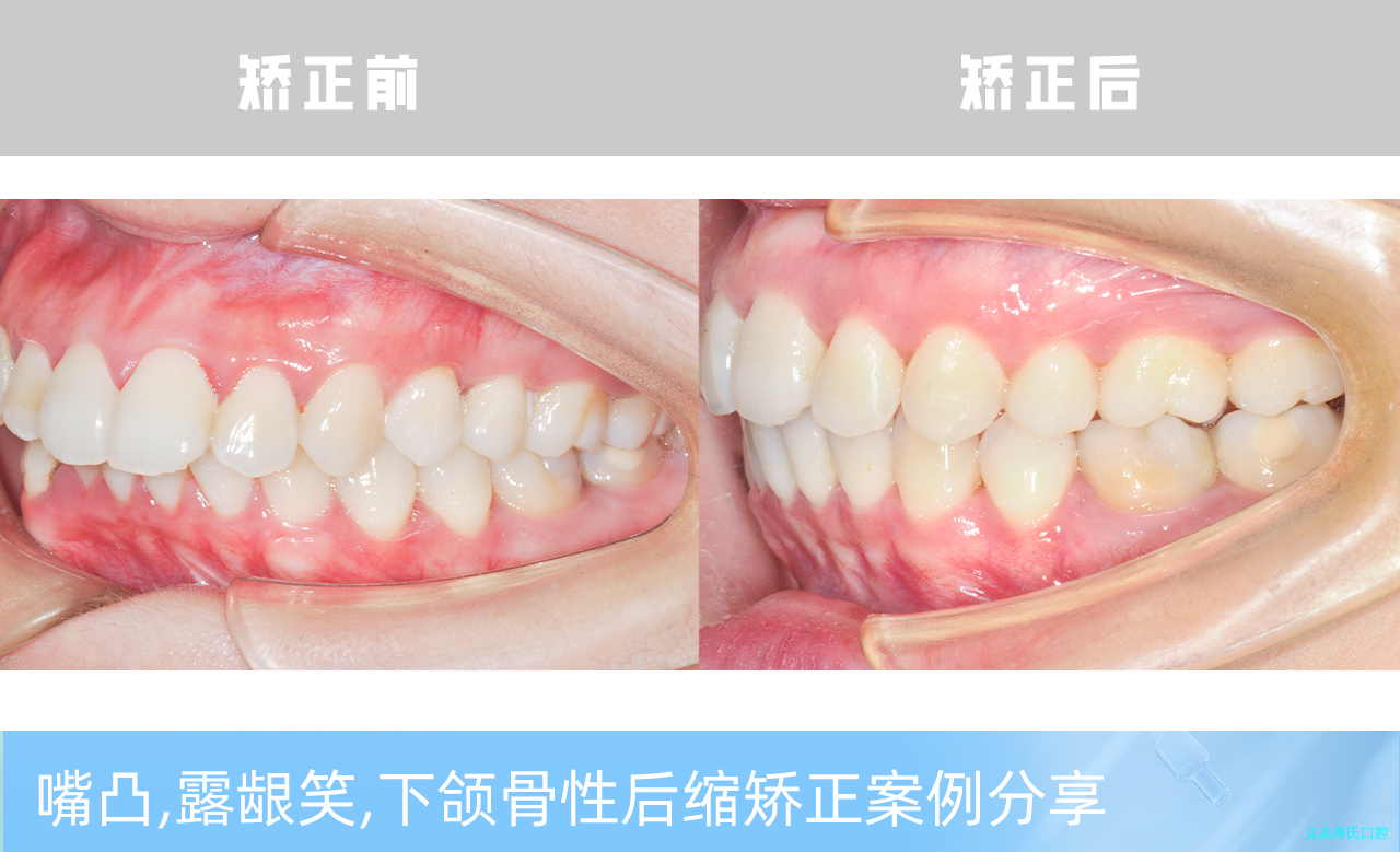 义乌傅氏口腔嘴凸，露龈笑，下颌骨性后缩矫正案例分享！