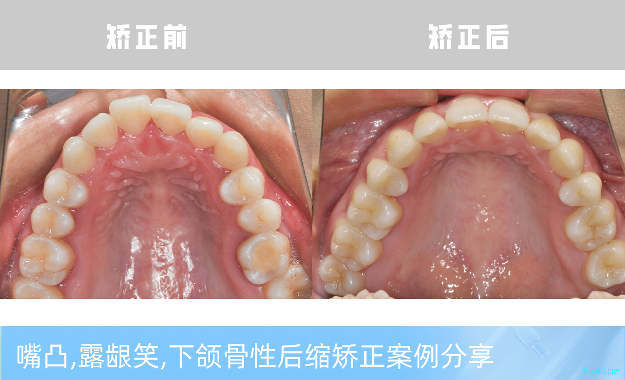 义乌傅氏口腔嘴凸，露龈笑，下颌骨性后缩矫正案例分享！