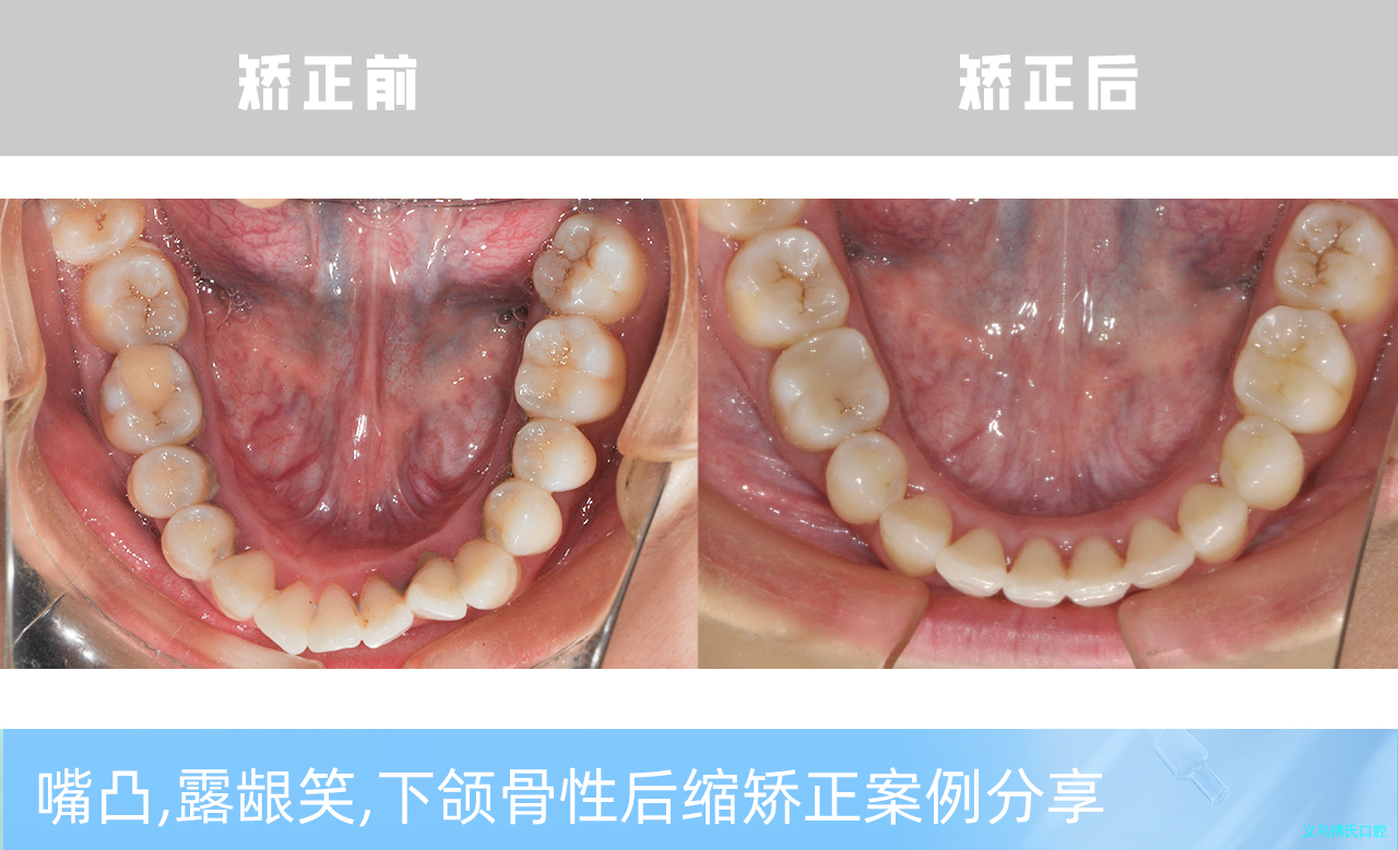 义乌傅氏口腔嘴凸，露龈笑，下颌骨性后缩矫正案例分享！
