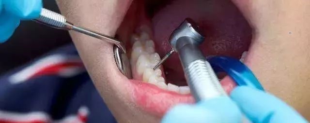 补牙怎么成了钻牙了? 补牙怎么成了钻牙了?