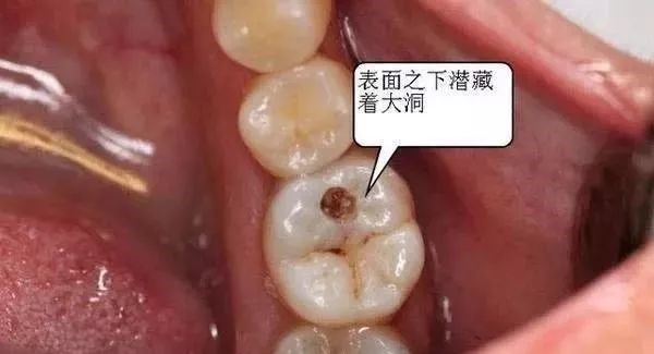 补牙怎么成了钻牙了? 补牙怎么成了钻牙了?