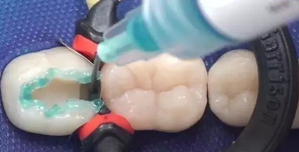 补牙怎么成了钻牙了? 补牙怎么成了钻牙了?