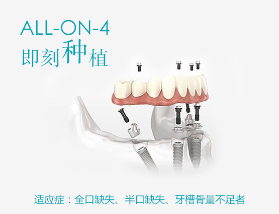 ALL-ON-4即刻种植