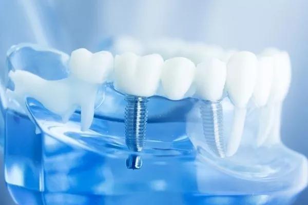种植牙到底能用多久，能用一辈子吗？—义乌傅氏口腔