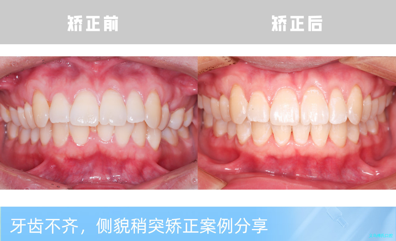 义乌傅氏口腔牙齿不齐侧貌稍突矫正案例分享！