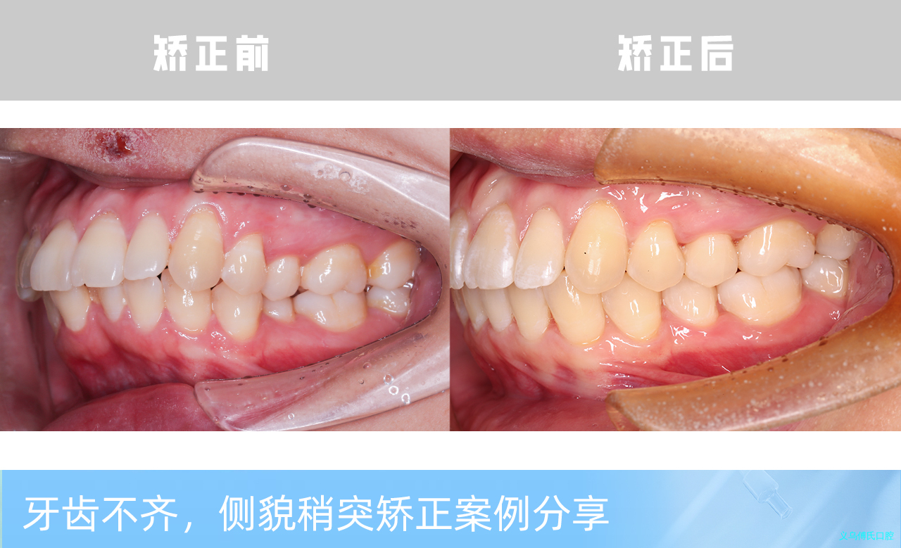 义乌傅氏口腔牙齿不齐侧貌稍突矫正案例分享！