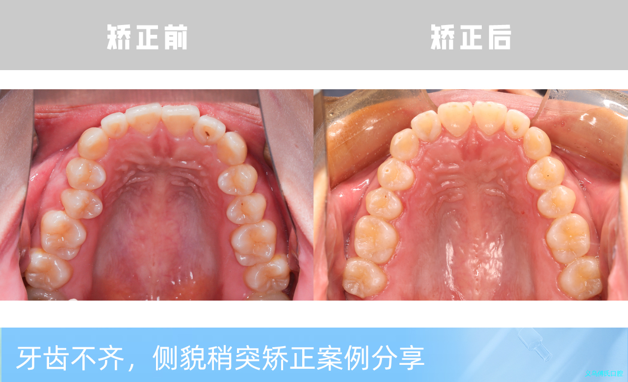 义乌傅氏口腔牙齿不齐侧貌稍突矫正案例分享！