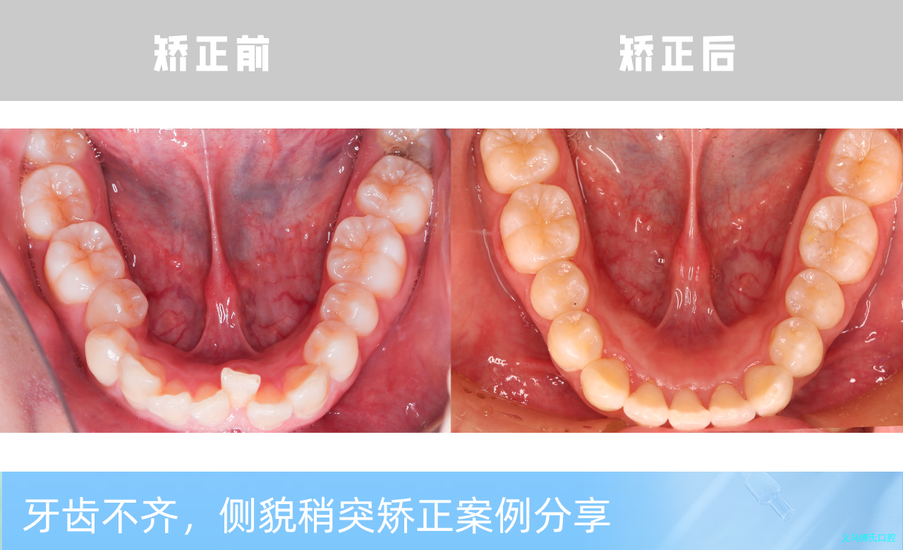 义乌傅氏口腔牙齿不齐侧貌稍突矫正案例分享！
