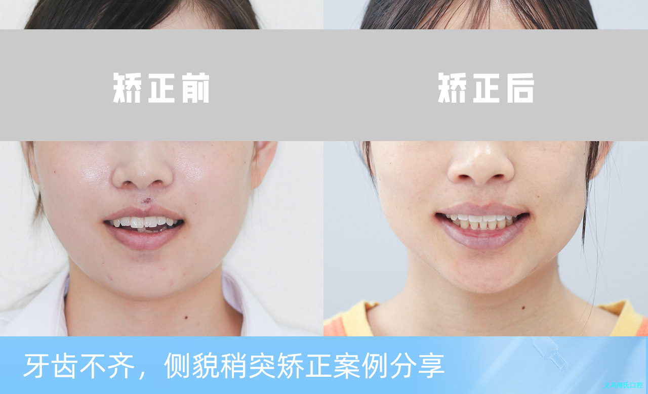 义乌傅氏口腔牙齿不齐侧貌稍突矫正案例分享！