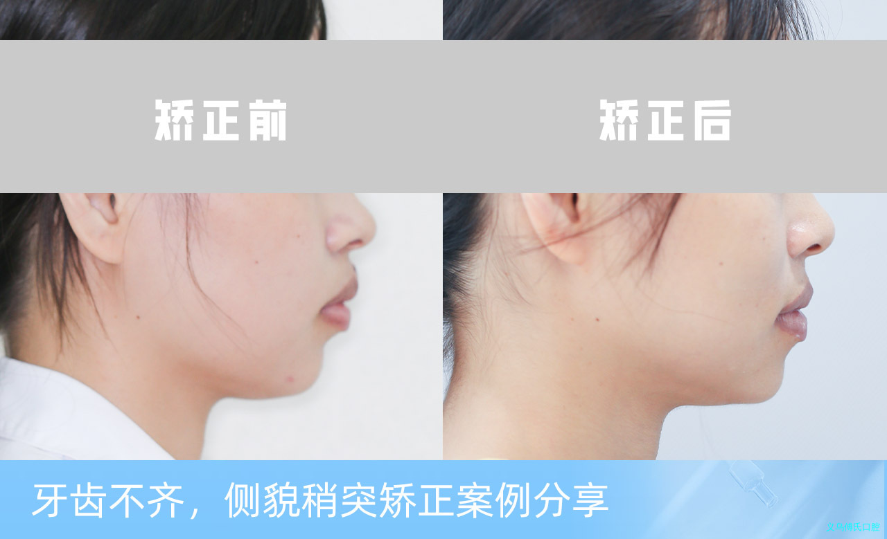 义乌傅氏口腔牙齿不齐侧貌稍突矫正案例分享！