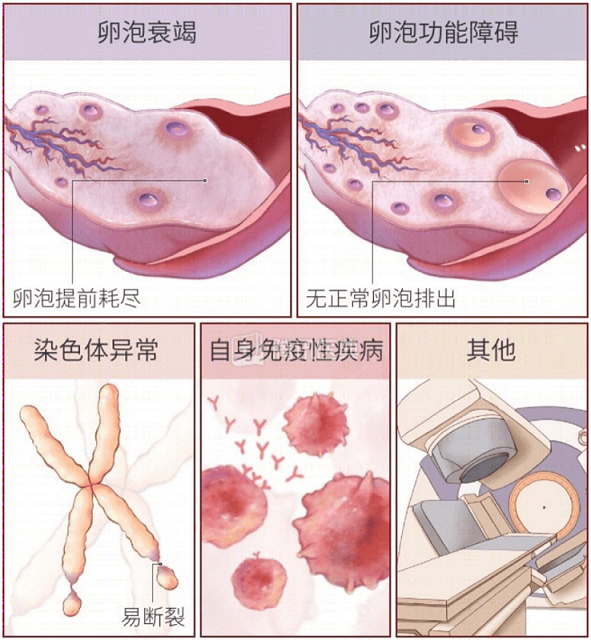 攻克卵巢早衰的“排头兵”——干细胞疗法