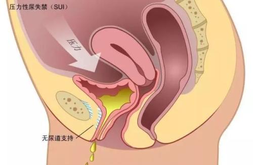 产后盆底肌肉康复治疗原则与个体化方案