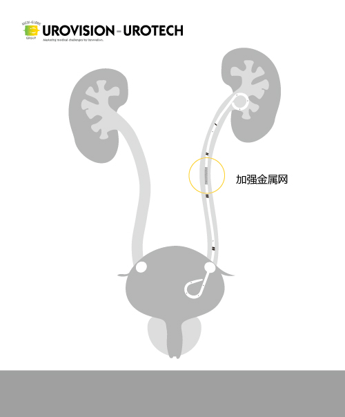 抗压输尿管支架套装（内置金属）