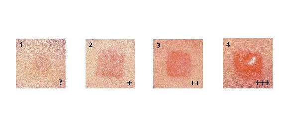 Irritation Tests