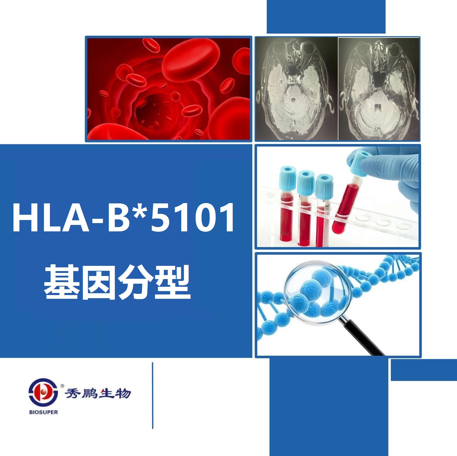 HLA-B*5101基因分型测定
