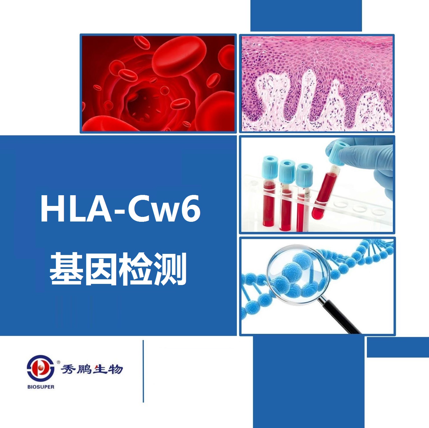 HLA-Cw6基因测定